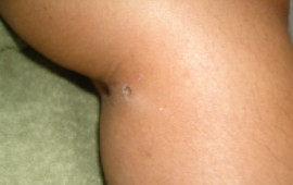 After Skin tag removal treatment in Madurai at GEM Skin, Hair and Laser Centre