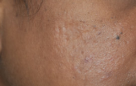 After Wart removal treatment in Madurai at GEM Skin, Hair and Laser Centre