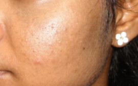 After Laser treatment for scar removing at GEM Skin, Hair and Laser Centre