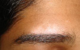 After Vitiligo treatment in Madurai at GEM Skin, Hair and Laser Centre