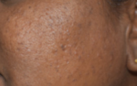 After Fairness treatment in Madurai at GEM Skin, Hair and Laser Centre