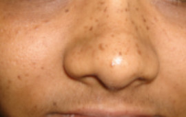 Before Anti pigmentation treatment in Madurai at GEM Skin, Hair and Laser Centre