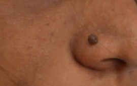 Before Mole removing treatment in Madurai at GEM Skin, Hair and Laser Centre