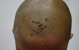Before Weight loss treatment in Madurai at GEM Skin, Hair and Laser Centre