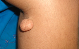Before Skin tag removal treatment in Madurai at GEM Skin, Hair and Laser Centre