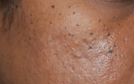 Before Wart removal treatment in Madurai at GEM Skin, Hair and Laser Centre