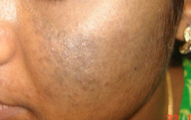 Before Laser treatment for scar removing at GEM Skin, Hair and Laser Centre