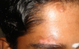 Before Vitiligo treatment in Madurai at GEM Skin, Hair and Laser Centre