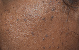 Before Fairness treatment in Madurai at GEM Skin, Hair and Laser Centre