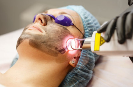 Corbon peel - Microdermabrasion treatment in Madurai at GEM Skin, Hair and Laser Centre