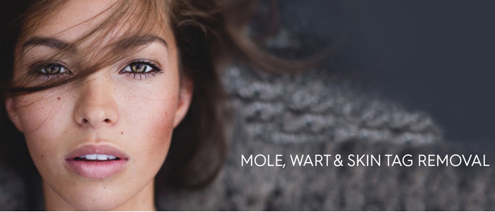 Mole and wart - Mole removing treatment in Madurai at GEM Skin, Hair and Laser Centre