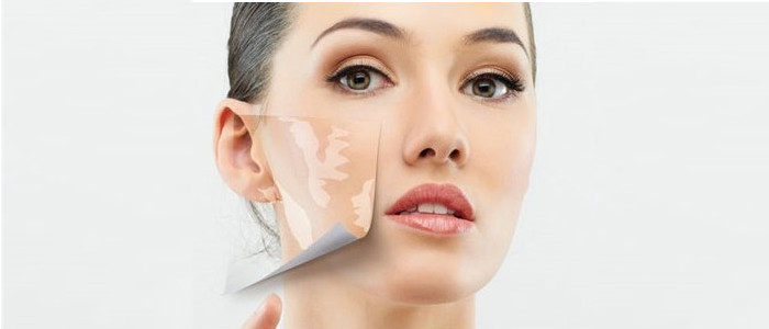 Vitiligo top - Vitiligo treatment in Madurai at GEM Skin, Hair and Laser Centre