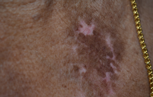 Eximer after - Laser treatment for skin problems at GEM Skin, Hair and Laser Centre