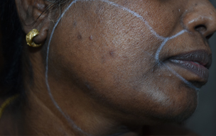 Lhr after - Hain loss problem in Madurai at GEM Skin, Hair and Laser Centre