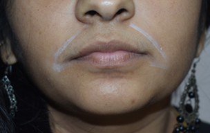 Lhr after - Laser hair removal treatment in Madurai at GEM Skin, Hair and Laser Centre