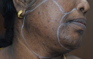 Lhr before - Dandruff treatment in Madurai at GEM Skin, Hair and Laser Centre