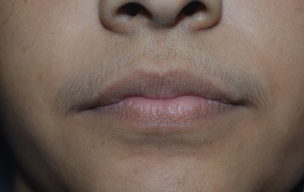 Lhr before - Laser skin toning treatment in Madurai at GEM Skin, Hair and Laser Centre
