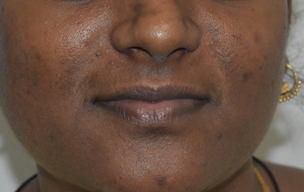 Peel before - Laser treatment for pimple at GEM Skin, Hair and Laser Centre