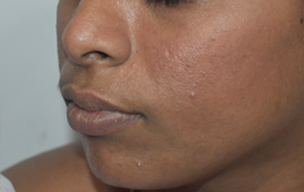 Peel after - Laser treatment for acne scars at GEM Skin, Hair and Laser Centre