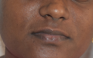 Peel after - Clear skin treatment in Madurai at GEM Skin, Hair and Laser Centre