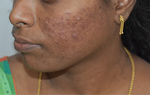Peel before - Acne removing treatment in Madurai at GEM Skin, Hair and Laser Centre