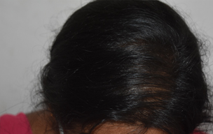 PRP after - PRP treatment for hair growth in Madurai at GEM Skin, Hair and Laser Centre