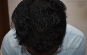 PRP after - Hair fall treatment in Madurai at GEM Skin, Hair and Laser Centre