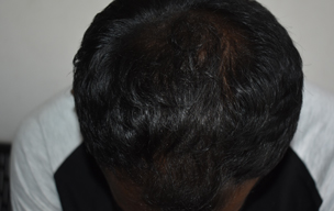 PRP after - Laser treatment for hair problems at GEM Skin, Hair and Laser Centre