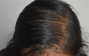 PRP before - Hair restoration treatment in Madurai at GEM Skin, Hair and Laser Centre