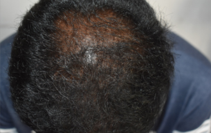 PRP before - Hair loss solution treatment in Madurai at GEM Skin, Hair and Laser Centre