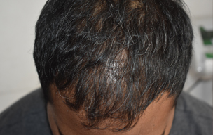 PRP before - Hair loss treatment in Madurai at GEM Skin, Hair and Laser Centre