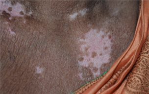 Rani eximer before - Mensturation problems at GEM Skin, Hair and Laser Centre