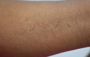 Tatto after - Multicoloured tattoo removal treatment in Madurai at GEM Skin, Hair and Laser Centre