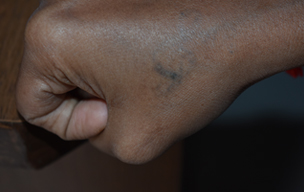 Tatto after - Tattoo reduction treatment in Madurai at GEM Skin, Hair and Laser Centre