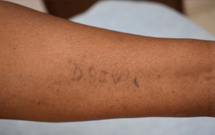 Tatto before - Laser treatment for tattoo removing at GEM Skin, Hair and Laser Centre
