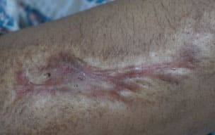 Fractionalaf - Laser treatment for scar removal in Madurai at GEM Skin, Hair and Laser Centre