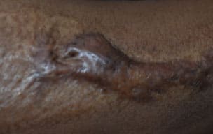 Fractionalbe - Traumatic scar treatment in Madurai at GEM Skin, Hair and Laser Centre