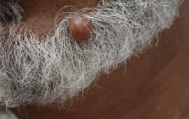 Largeskintag - Weight reduction treatment in Madurai at GEM Skin, Hair and Laser Centre