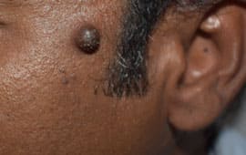 Moletreatment - Skin tag removal treatment in Madurai at GEM Skin, Hair and Laser Centre