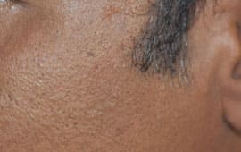 Moletreatment - Wart removal treatment in Madurai at GEM Skin, Hair and Laser Centre