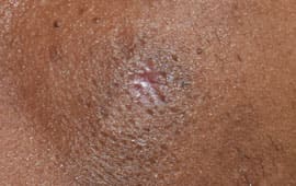 Moletreatmentafter - Weight loss treatment in Madurai at GEM Skin, Hair and Laser Centre