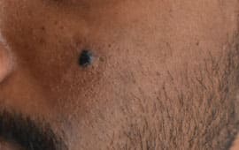 Moletreatmentbefore - Fairness treatment in Madurai at GEM Skin, Hair and Laser Centre