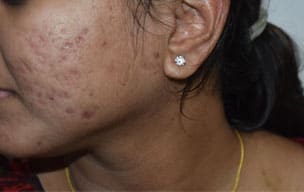 Sacrbefore - Acne scar treatment in Madurai at GEM Skin, Hair and Laser Centre
