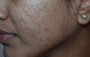 Scarafter - Chicken scar treatment in Madurai at GEM Skin, Hair and Laser Centre