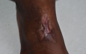 Scartreatment - Swelling in the skin at GEM Skin, Hair and Laser Centre