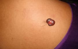 Skintag - Mole removing treatment in Madurai at GEM Skin, Hair and Laser Centre