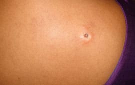Skintag - Skin tag removal treatment in Madurai at GEM Skin, Hair and Laser Centre