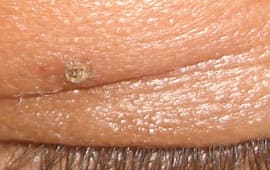 Wartafter - Fairness treatment in Madurai at GEM Skin, Hair and Laser Centre