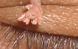 Wartbefore - Wart removal treatment in Madurai at GEM Skin, Hair and Laser Centre