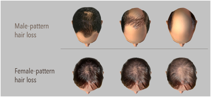 Hair Fall Treatment in Madurai, Hair Loss Treatment in Madurai
